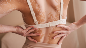 vitiligo aceitação