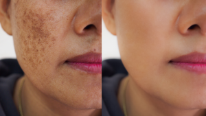 Melasma grávidas